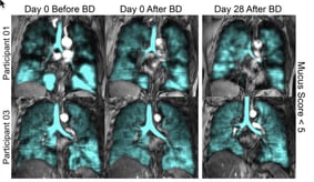 Cursor_and_Asthma_Control__Airway_Mucus__and_129Xe_MRI_Ventilation_After_a_Single_Benralizumab_Dose_-_CHEST