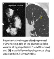 Cursor_and_Mucus_Plugs_in_Asthma_at_CT_Associated_with_Regional_Ventilation_Defects_at_3He_MRI___Radiology