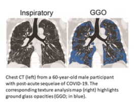 Cursor_and_Quantitative_Chest_CT_Assessment_of_Small_Airways_Disease_in_Post-Acute_SARS-CoV-2_Infection___Radiology