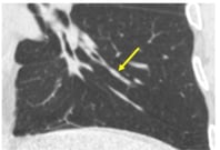 Sputum_Mucus_Rheology__Inflammatory_Profile__and_CT_Mucus_Scores_in_Severe_Asthma